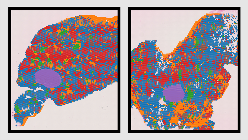 Landmark atlas reveals how aging breast tissue shapes breast cancer risk